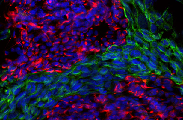 Immunoflourescence of mixed fibroblasts and PC12 cells labeled with anti-peripherin (cat. 1630-PER, red, 1:500) and anti-vimentin (cat. 2105-VIM, green, 1:10,000). The blue is Hoechst staining nuclear DNA. Peripherin is labeled in only the PC12 cells cytoplasmic filaments and vimentin is only labeled in the fibroblasts intermediate filaments where peripherin is not present.