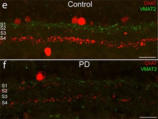 Immunostaining against ChAT (red) and VMAT2 (Cat no. 2250-VMAT2C, 1:200, green) in retinal sections of control (e) and Parkinson's Desease (f) patients. Image from publication CC-BY-4.0. PMID: 37013599