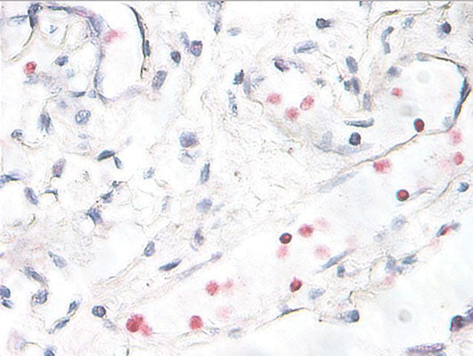 Immunostaining of human breast cancer tissue showing p38 when phosphorylated at Thr180/Tyr182 (red, 1:250). Photo courtesy of Patsy Ruegg.