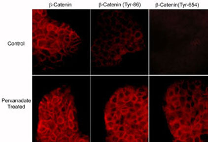 Immunocytochemical labeling of phosphorylated β-Catenin in control and pervanadate-treated A431 cells. The cells were labeled with mouse monoclonal β-Catenin (CM1181) or rabbit polyclonal β-Catenin (Tyr-86) or β-Catenin (Y654) antibodies, then the antibodies were detected using appropriate secondary antibodies conjugated to Cy3.