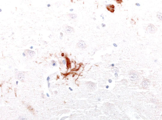 Immunohistochemical presence of tau in a neurofibrillary tangle in the remnant of a cortical neuron of an Alzheimer's Disease patient. Anti-Tau antibody (1:10,000) was incubated with formalin-fixed, paraffin-embedded sectioned material from Alzheimer's brains. Primary antibody was visualized with HRP-labeled goat anti-chicken IgY. Dr. Randy Woltjer, Oregon Health & Sciences University.